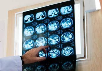Nodulo polmonare che cose come si diagnostica e quando intervenire